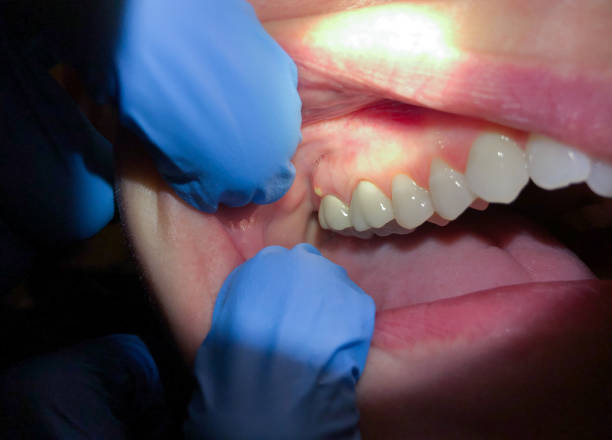Best Emergency Treatment for Dental Infections or Abscesses in Itta Bena, MS